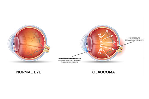 Behandeling glaucoom: oogdruppeltherapie, laserbehandeling of operatie