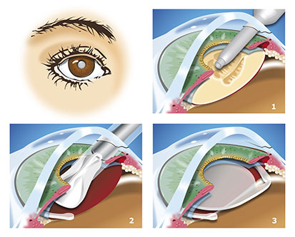 Behandeling cataract door cataractoperatie