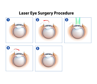 laserbehandeling & lensimplantatie